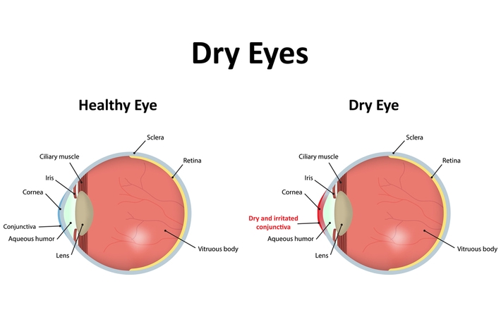 Illustrative comparison of dry eyes. Two cross sections are shown with the healthy eye on the left and dry eye on the right. The healthy has eye has components such as cornea, retina, sclera, lens and others indicated. The dry eye illustration has the same but shows an irritated and dry conjunctiva.