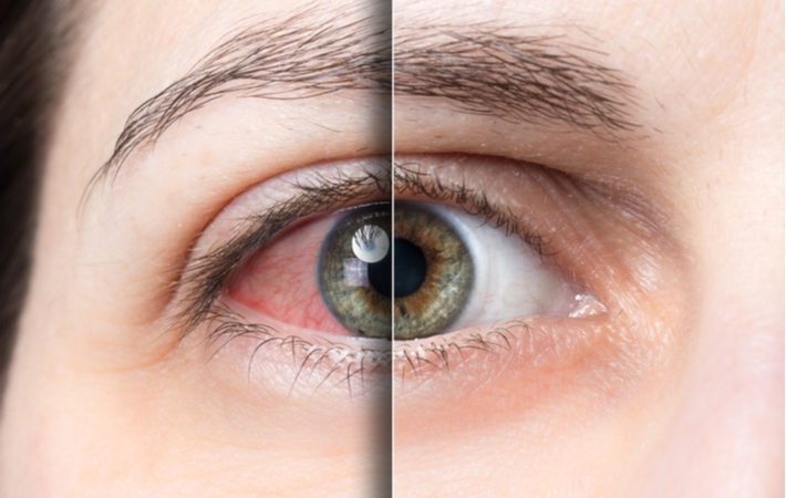 A close up of a woman's eye with a before and after comparison of the effects of dry eye