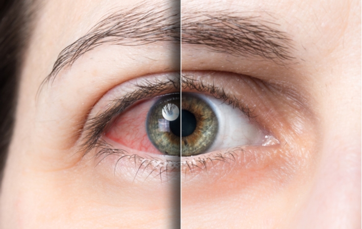 https://discovereyecare.com/wp-content/uploads/2022/01/before-and-after-dry-eye.jpg