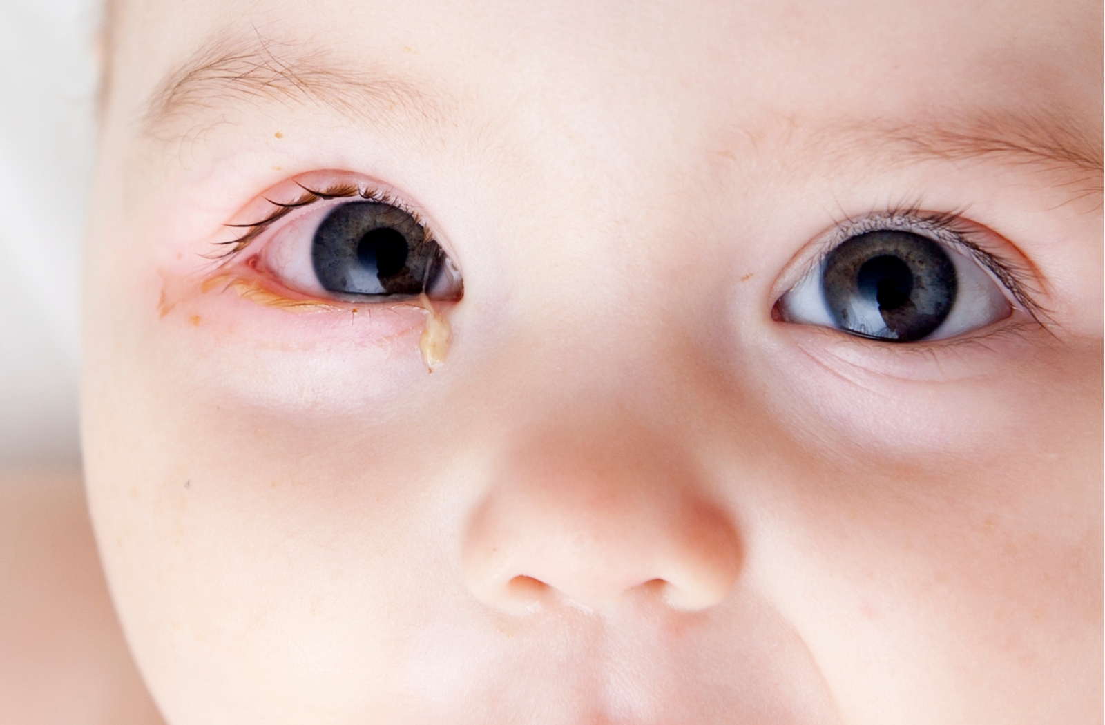 A close up of a baby with pink eye in their right eye