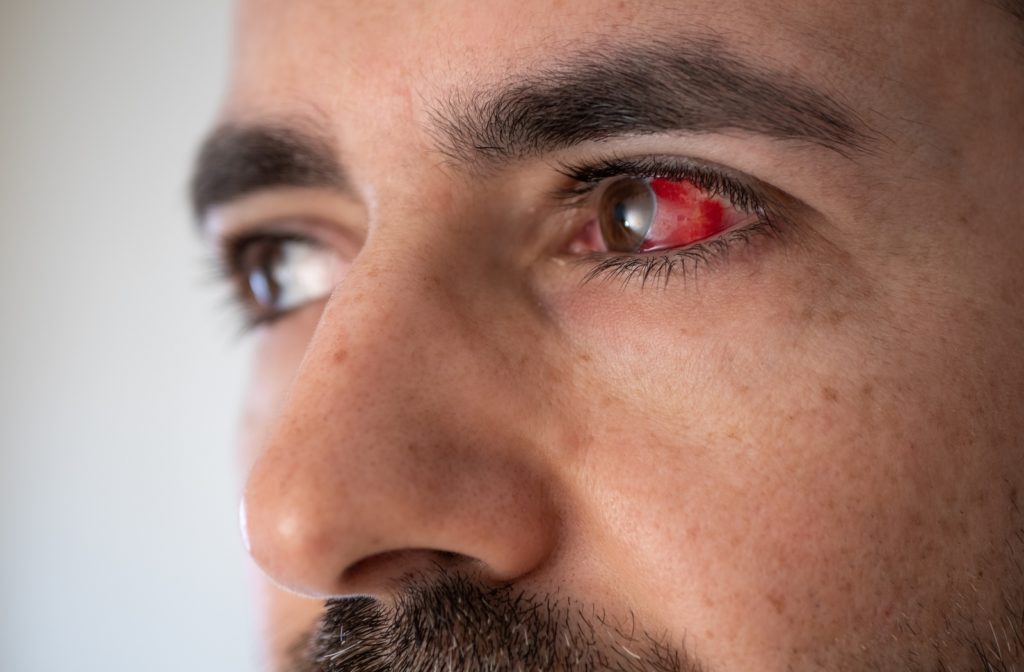 A man looking to his right slightly to show the blood vessel in his left eye