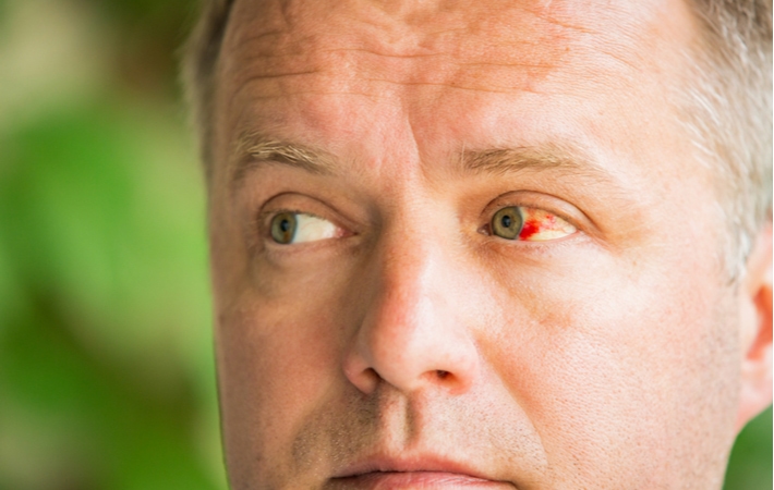 A man with a broken blood vessel in his left eye as he looks to the left, in front of a blurred green background