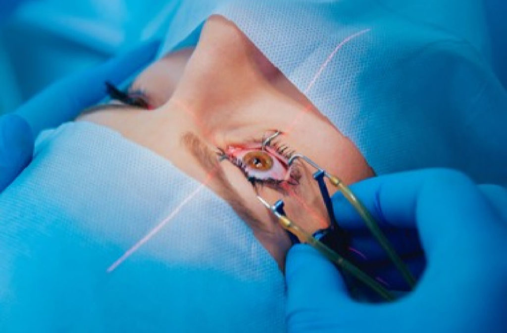 A close-up of a female patient undergoing laser eye surgery for nearsightedness to alter the shape of the cornea with a laser.