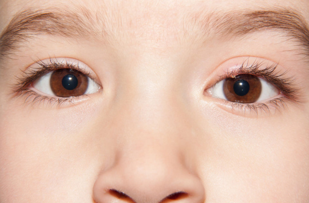Close-up of a child with a stye on the eyelid.