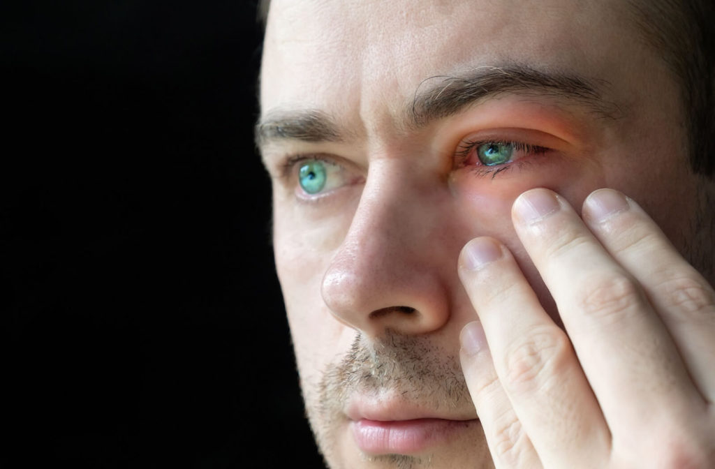 A close-up of a man with an inflamed, red, irritated eye caused by blepharitis.