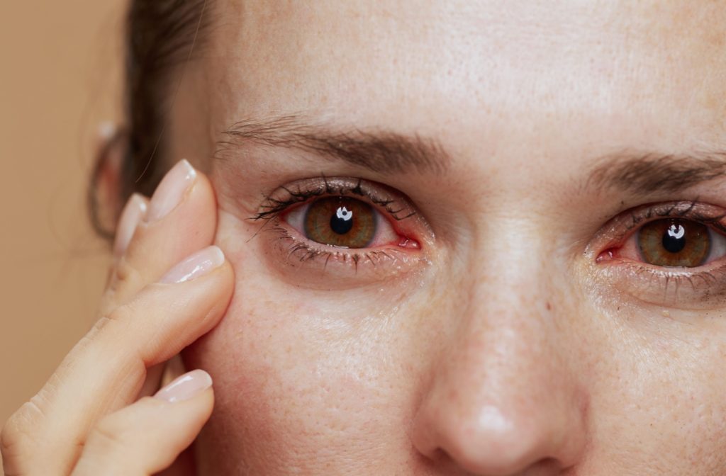 A closeup of a young woman with pink, irritated eyes.