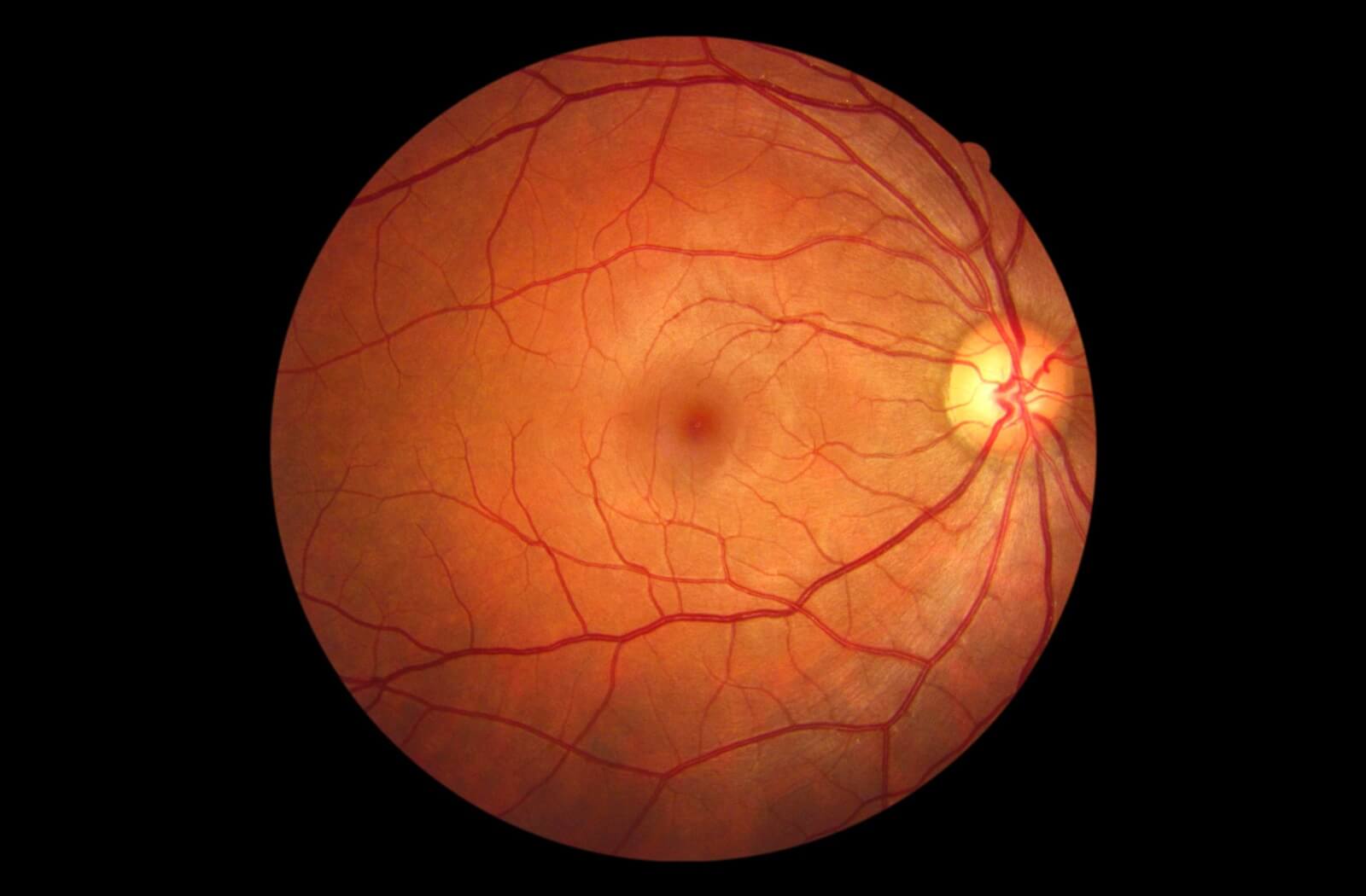 An example of retinal imaging showing a patient's retina.