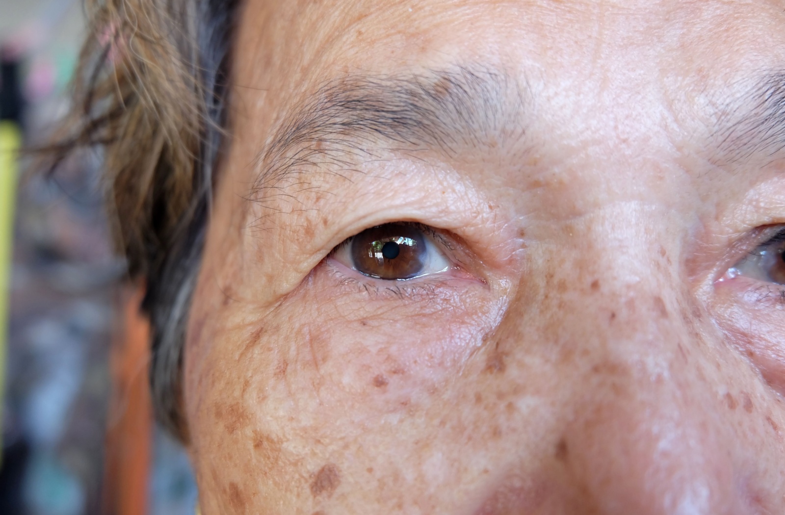 Close-up of older adult’s eyes showing early signs of cataracts and visible lens cloudiness