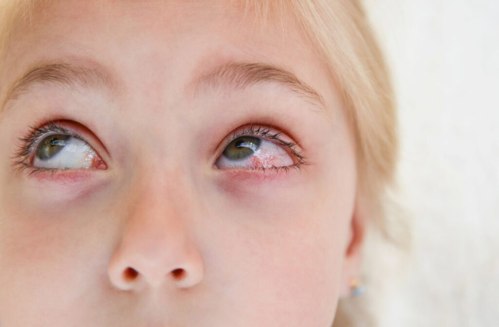 A child looks upward, showing visible redness in eye.