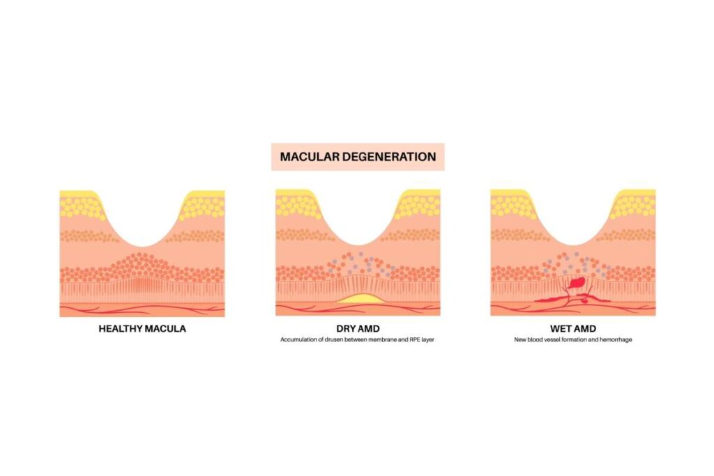 Medical illustration showing the difference between a healthy macula, dry age-related macular degeneration (AMD), and wet AMD with new blood vessel growth.