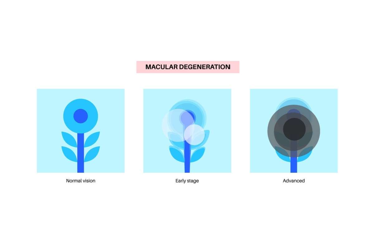 Diagram showing how vision changes with macular degeneration, progressing from normal vision to early-stage blurriness and advanced central vision loss.