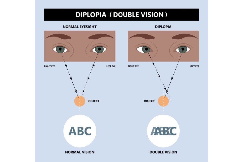An infographic depicting the difference between normal eyesight and diplopia.