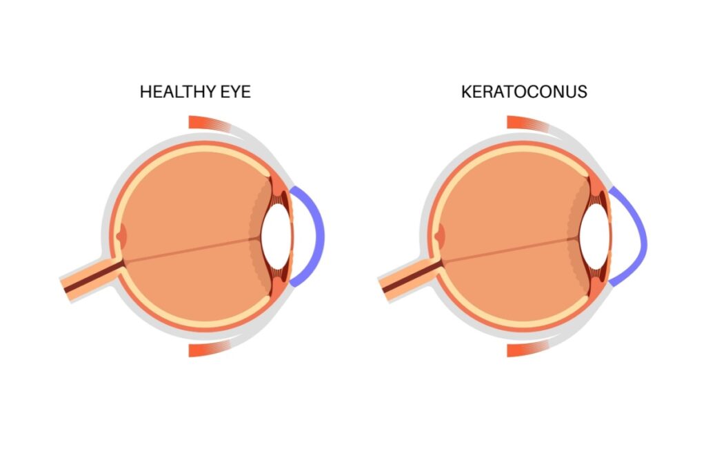 Medical diagram comparing normal round cornea to cone-shaped cornea in keratoconus condition.