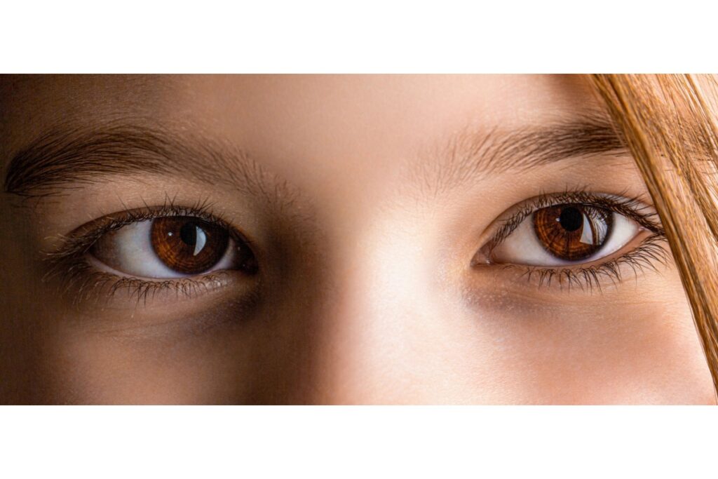 Up close image of the eyes of a girl with strabismus.
