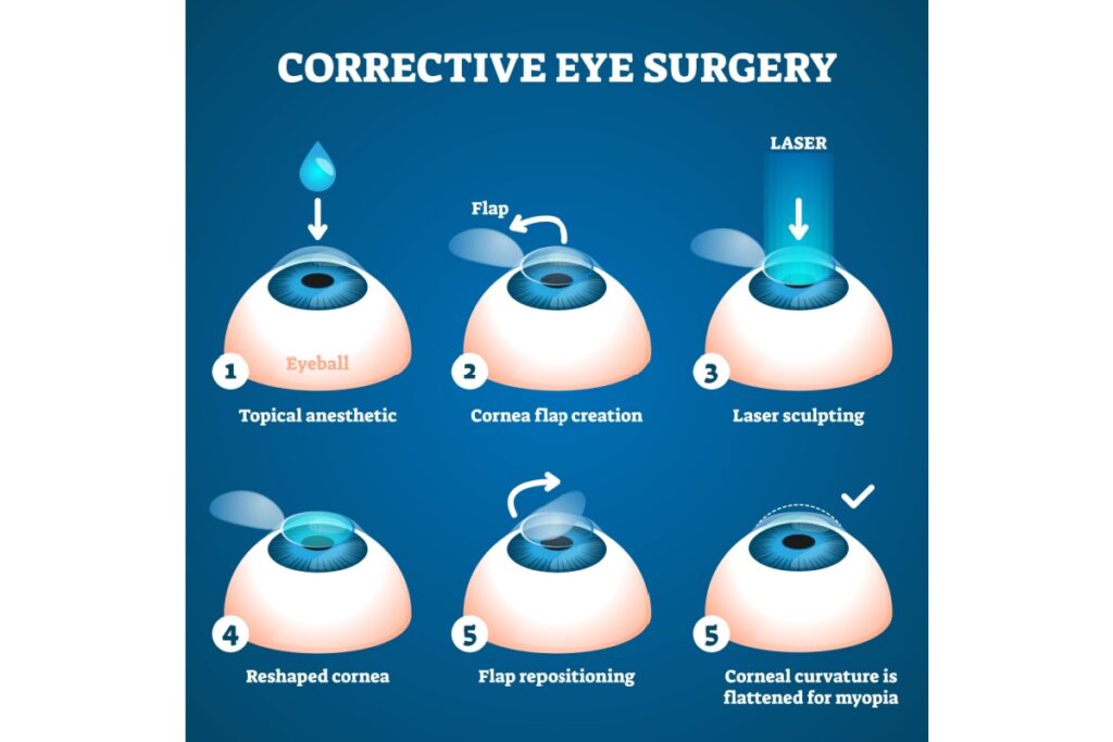 Illustration showing the steps involved for laser eye surgery