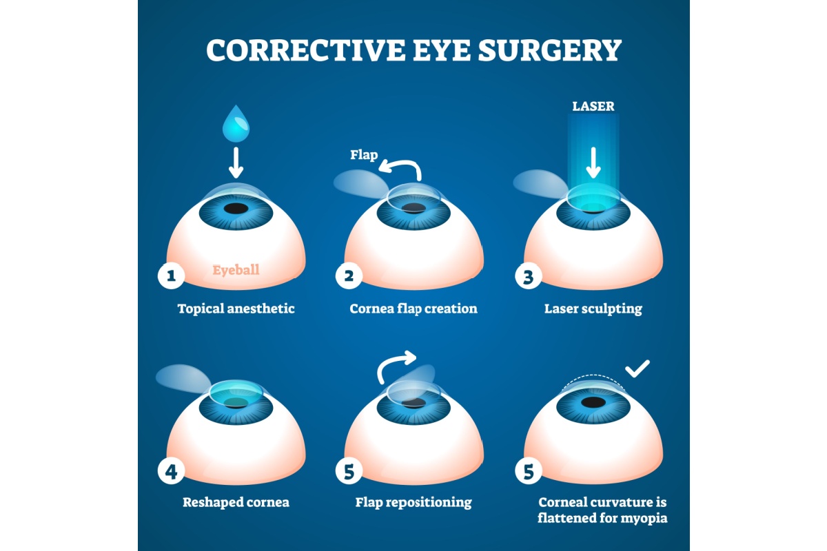 Illustration showing the steps involved for laser eye surgery